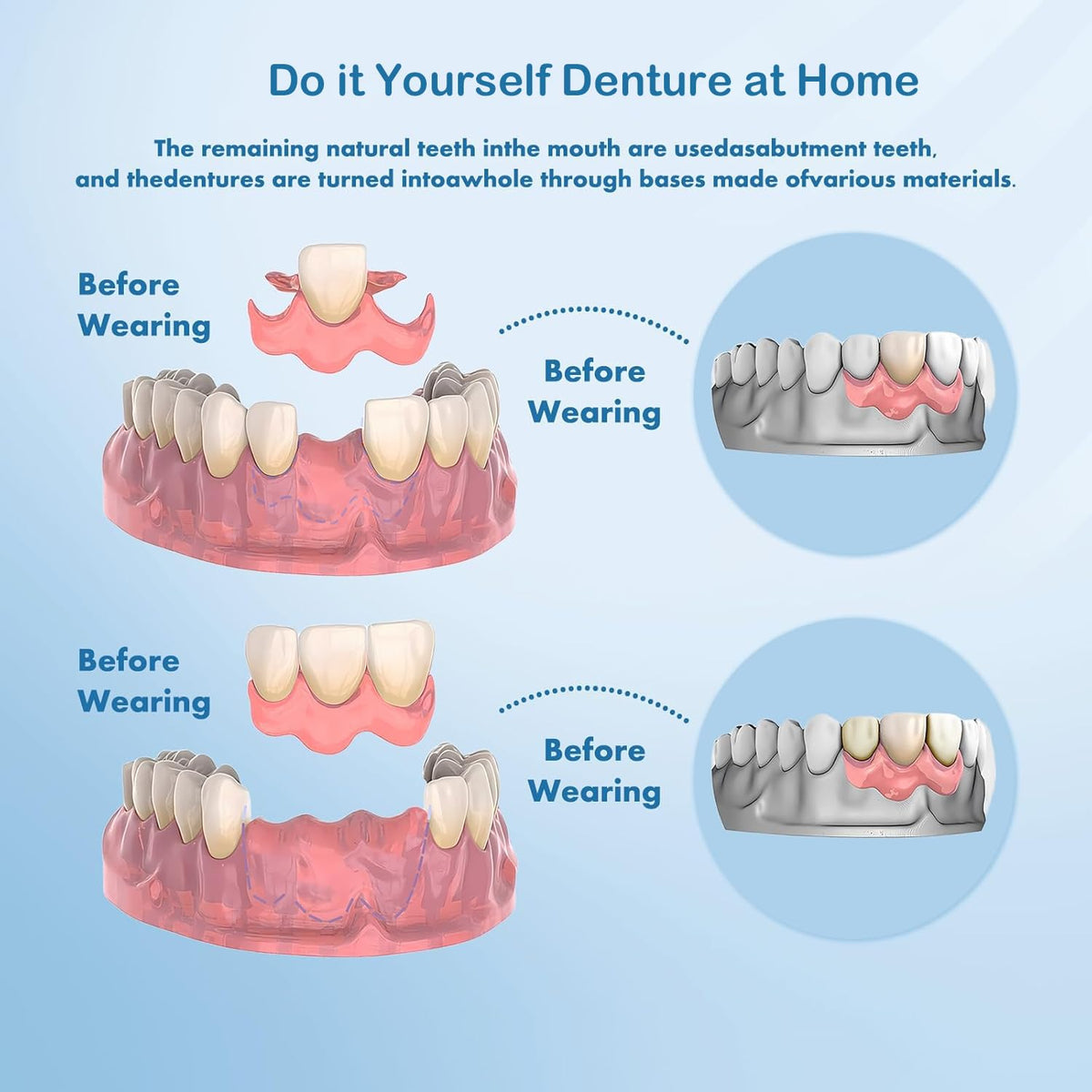 DIY Denture Complete Kit with Impression Material, Gum Material, Components for Top and Bottom Full or Partial Dentures N1304